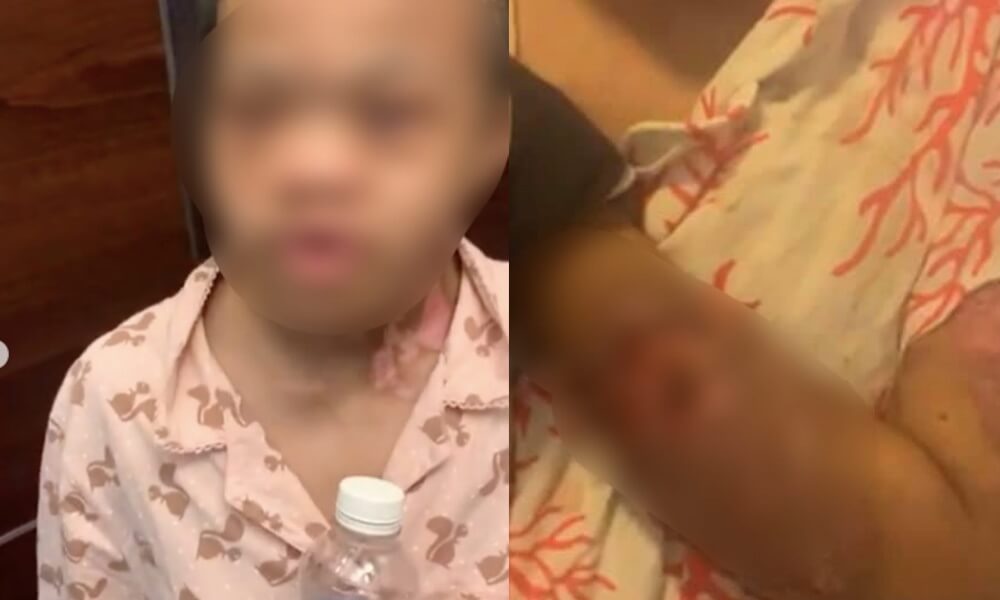 “Kesan lecur tangan Bella mungkin kena air panas,” - Pakar bedah plastik